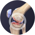 Joint Inflammation