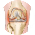 Osteoarthritis