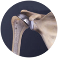 Bursitis